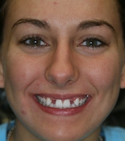 BAGLEY|LINDSEY| girl smiling with missing teeth