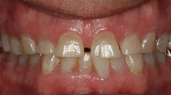 before5-1 teeth with large gap